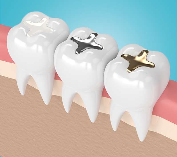 Denver Tooth Colored Fillings