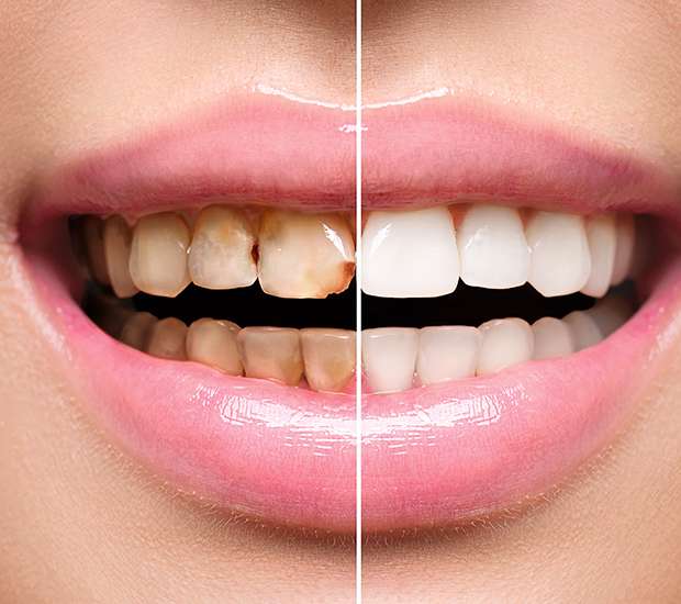 Denver Dental Implant Restoration